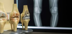 протезирование колена в иране